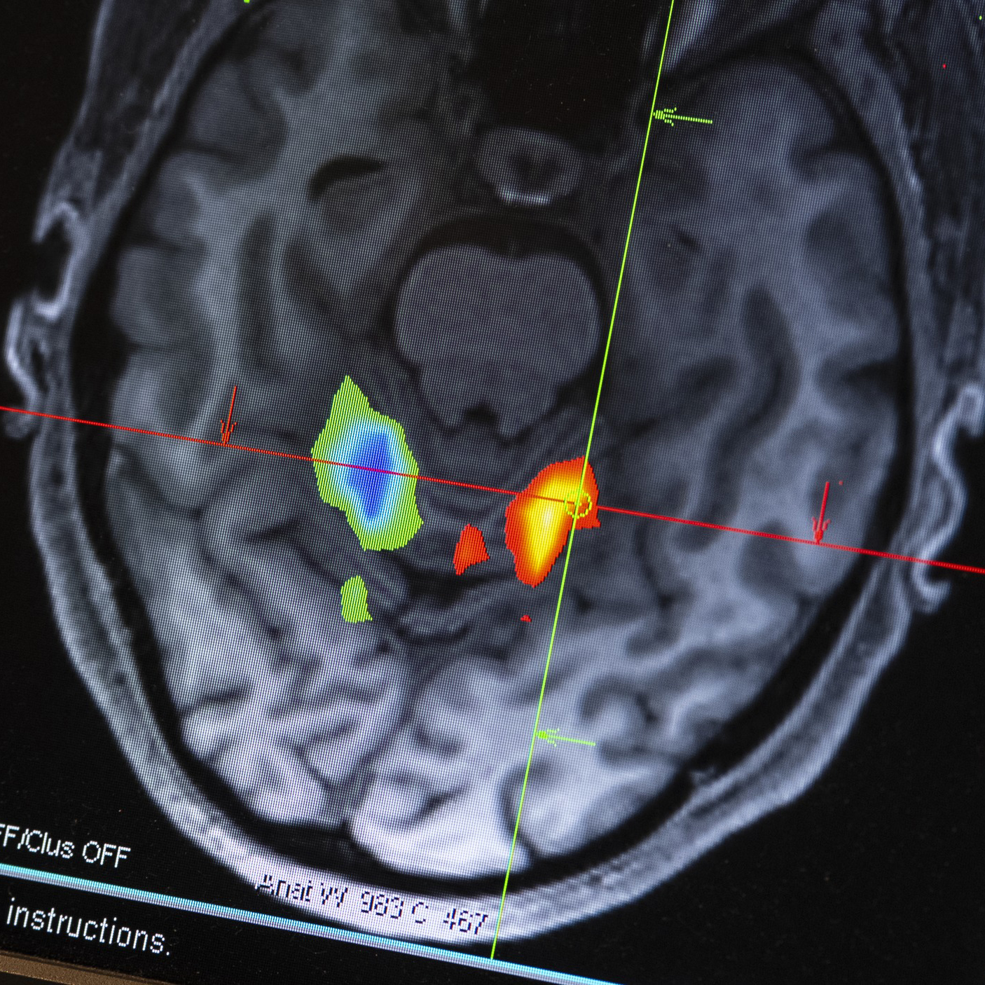 Picture of Researchers find studying curse words could help traumatic brain injury patients